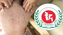 দেশে হামে এক দিনে আরও চার শিশুর মৃত্যু, শনাক্ত ৬৯